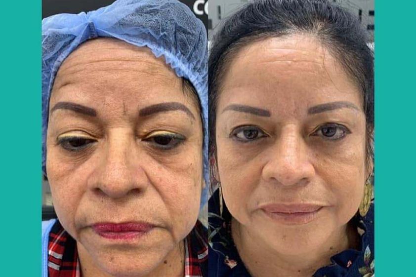 Rejuvenecimiento facial antes y después - 792907