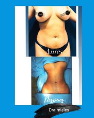 Lipoescultura - Dra. Mieles