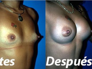mamoplastia-de-aumento-bogota-colombia