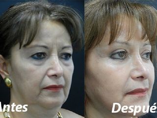 Cirugia de rejuvenecimiento facial