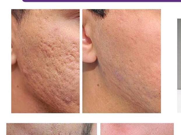 Ozonoterapia antes y despues de adelgazar Ozonoterapia antes y despues de adelgazar