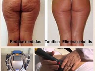 Antes y despues de eliminacion de celulitis