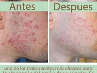 Antes y despues de tratamiento contra el acne