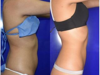 Lipolisis Láser - Innova Laser Center
