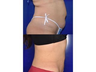 Lipolisis Láser - Innova Laser Center