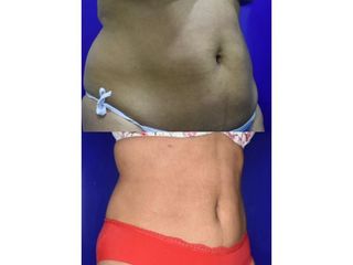 Lipolisis Láser - Innova Laser Center