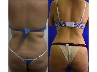 Lipolisis Láser - Innova Laser Center