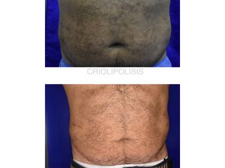 Criolipólisis - Innova Laser Center