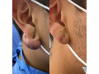 Cirugía reconstructiva (Queloide)- Innova Laser Center