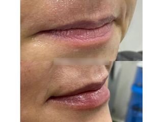 Aumento de labios - Innova Laser Center