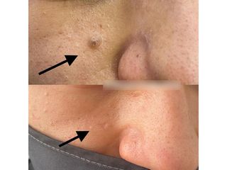 Verrugas - Innova Laser Center