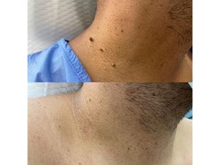 Verrugas - Innova Laser Center