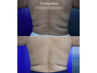 Criolipólisis - Innova Laser Center