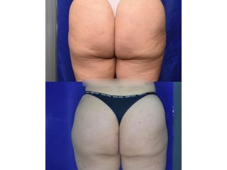 Criolipólisis - Innova Laser Center