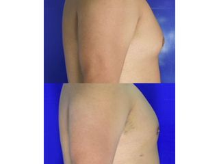 Criolipólisis - Innova Laser Center