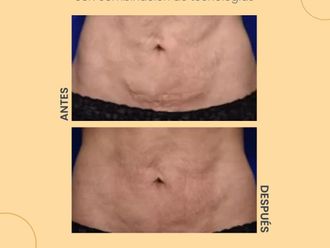 Celulitis antes y después - 854225