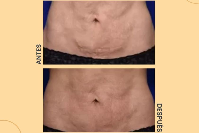 Celulitis antes y después - 854225
