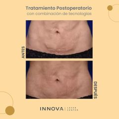 Celulitis - Innova Laser Center