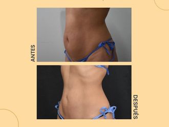 Lipólisis láser antes y después - 854229