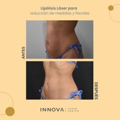 Lipólisis láser - Innova Laser Center