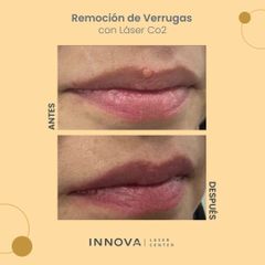 Verrugas - Innova Laser Center