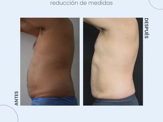 Lipólisis láser antes y después - 854236