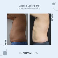 Lipólisis láser - Innova Laser Center