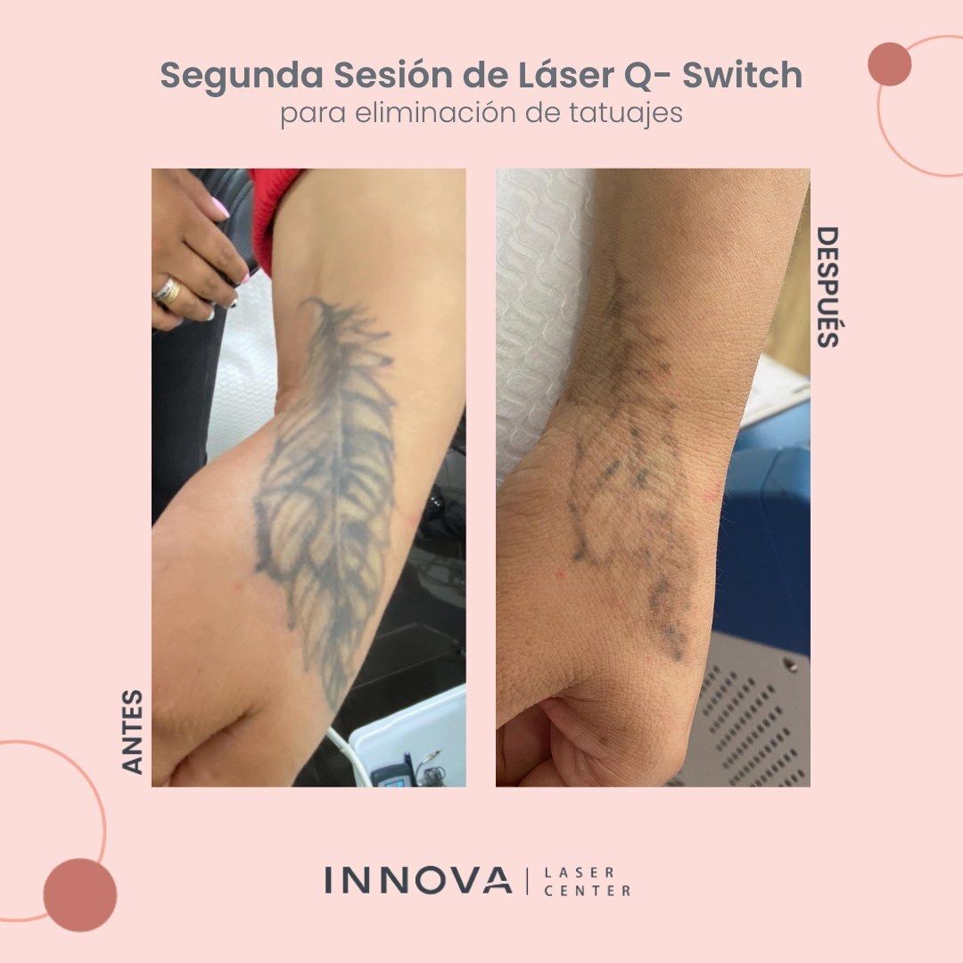 Borrar tatuajes Antes y después - Clinicasesteticas.com.co -  Clinicasesteticas.com.co