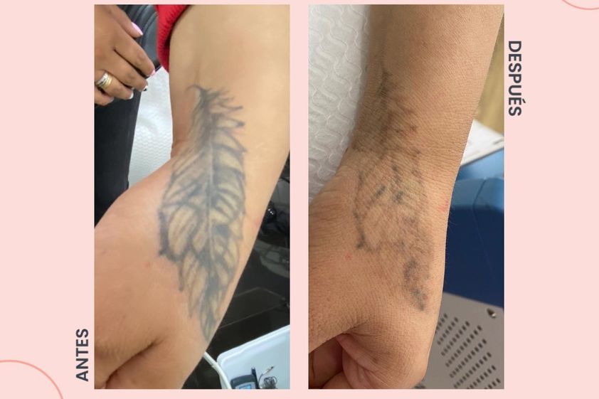 Borrar tatuajes antes y después - 854237