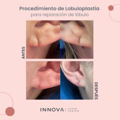 Lobuloplastia  - Innova Laser Center
