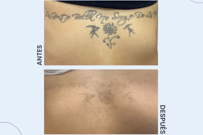 Borrar tatuajes antes y después - 854246
