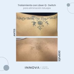 Borrar tatuajes - Innova Laser Center