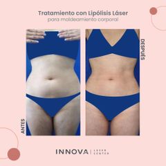 Lipólisis láser - Innova Laser Center