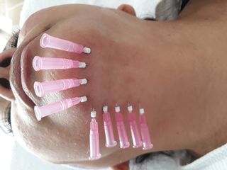 Rejuvenecimiento facial