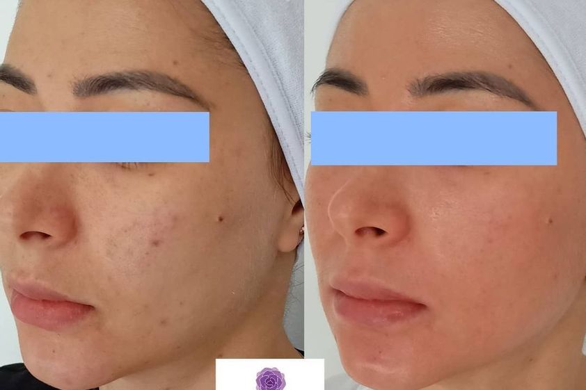 Peeling antes y después - 790186