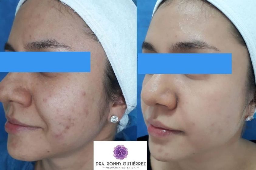 Peeling antes y después - 790188
