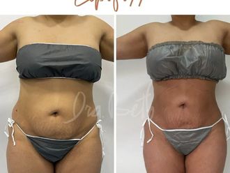 Tratamientos para adelgazar antes y después - 849661