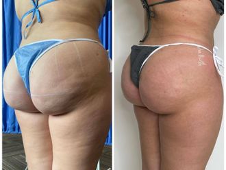 Celulitis antes y después - 849664
