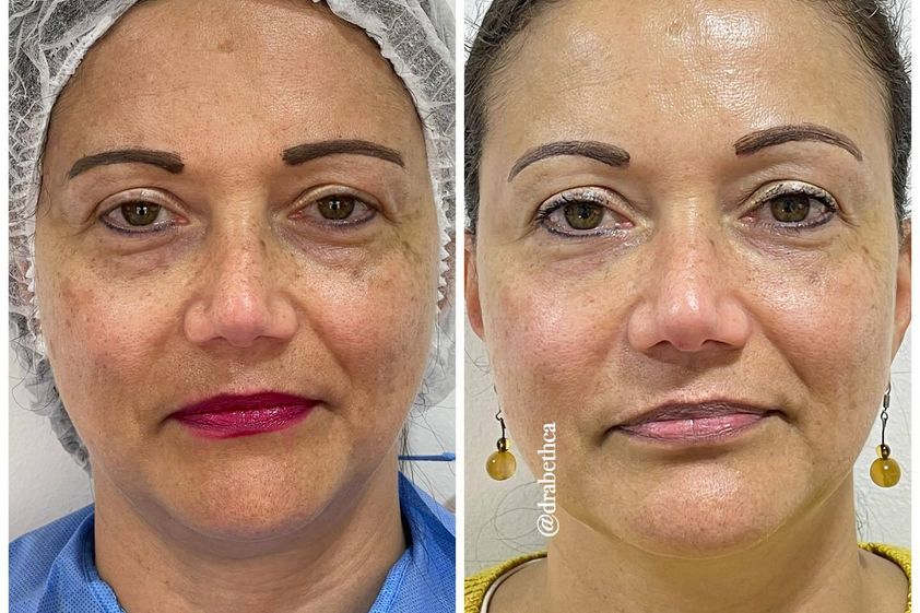 Eliminar ojeras antes y después - 849666