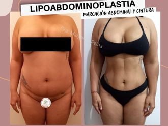 Lipoescultura antes y después - 852345