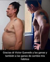 Abdominoplastia