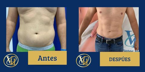 Abdominoplastia - Dr. Victor Hugo Quevedo