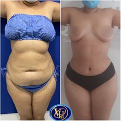 Lipoescultura - Dr. Victor Hugo Quevedo