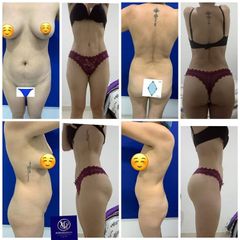 Lipoescultura - Dr. Victor Hugo Quevedo