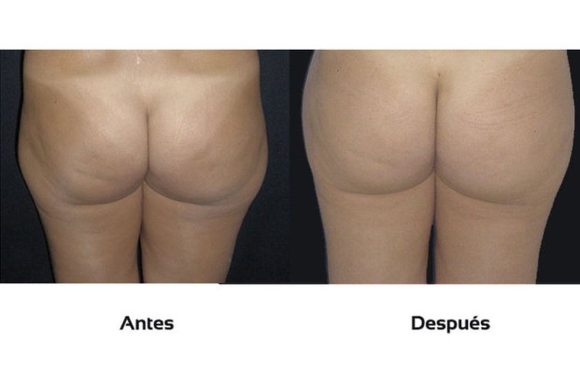 Celulitis antes y después - 511197