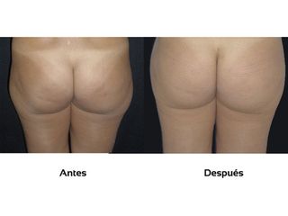Celulitis