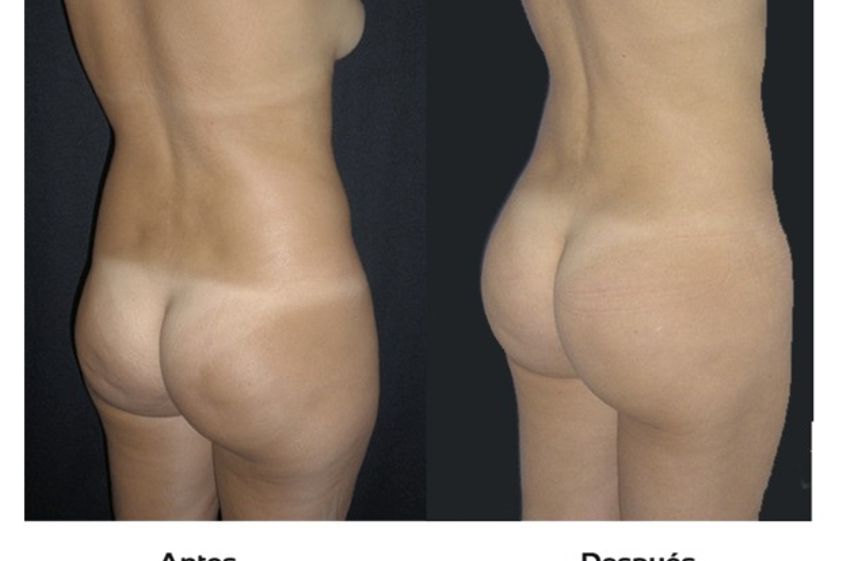Celulitis antes y después - 511202