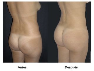 Tratamiento anti celulitis