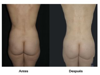 Tratamientos estéticos contra la celulitis