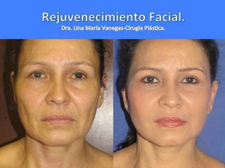 Antes y despues de rejuvenecimiento facial